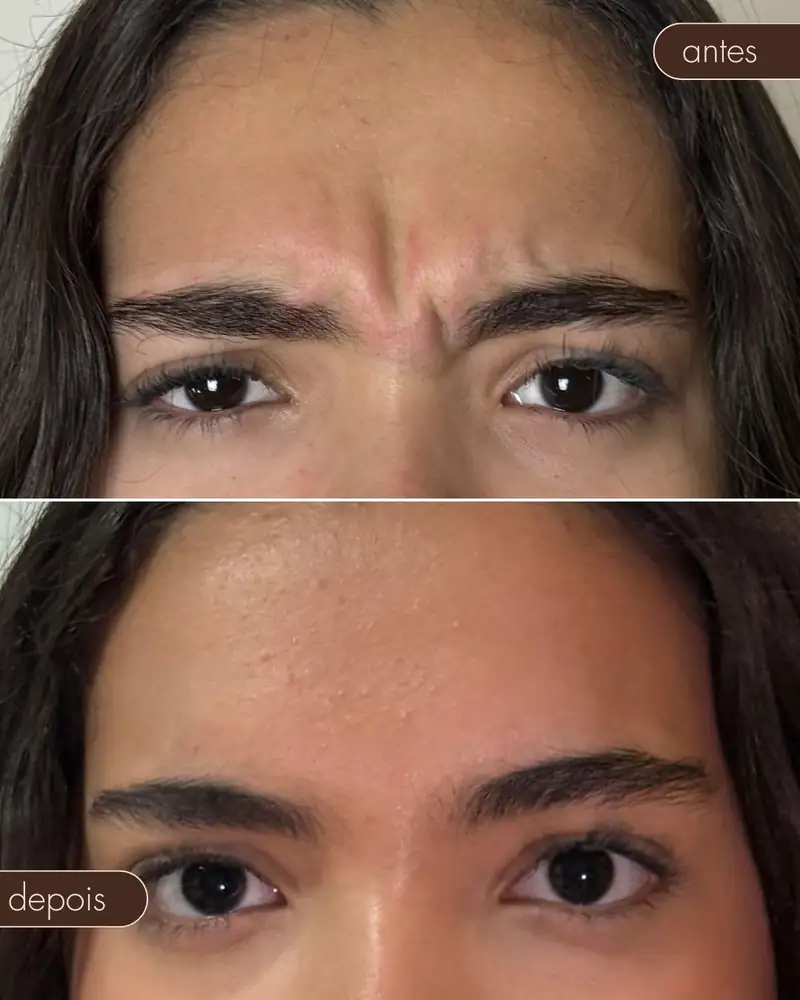 Antes e depois — Botox
